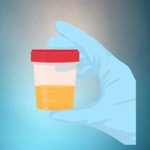 complete urine examination (cue)